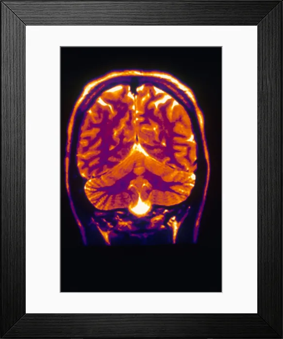 Framed Print : Normal MRI of Brain Framed Print : Normal MRI of Brain