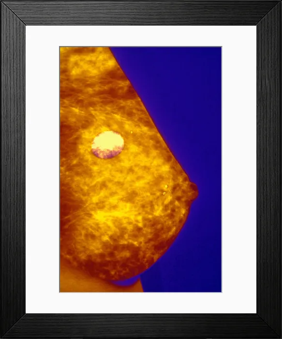 Framed Print : Mammogram. Color enhanced mammogram showing benign cyst Framed Print : Mammogram. Color enhanced mammogram showing benign cyst