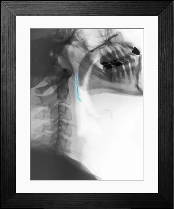 Framed Print : Neck x-ray of swallowed paper clip Framed Print : Neck x-ray of swallowed paper clip