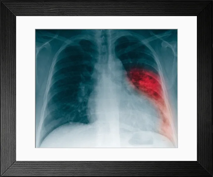 Framed Print : Pneumonia, X Ray