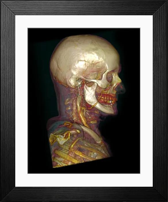 Framed Print : Male Skull & Arterial System Framed Print : Male Skull & Arterial System
