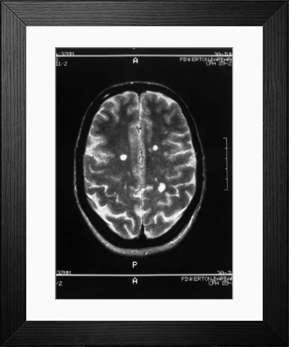 Framed Print : Multiple sclerosis Framed Print : Multiple sclerosis