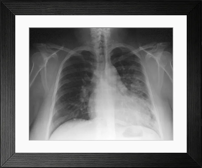Framed Print : Pneumonia, X Ray