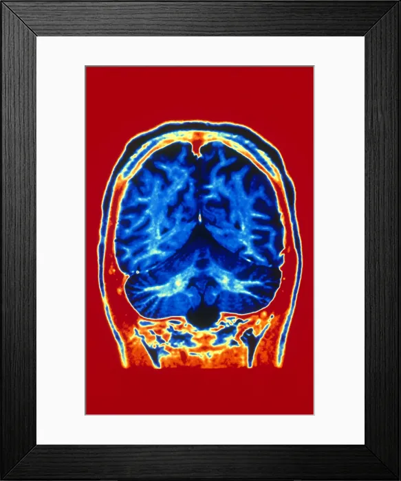 Framed Print : Normal MRI of Brain Framed Print : Normal MRI of Brain