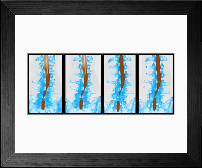 Framed Print : Spine, CT Scan Framed Print : Spine, CT Scan