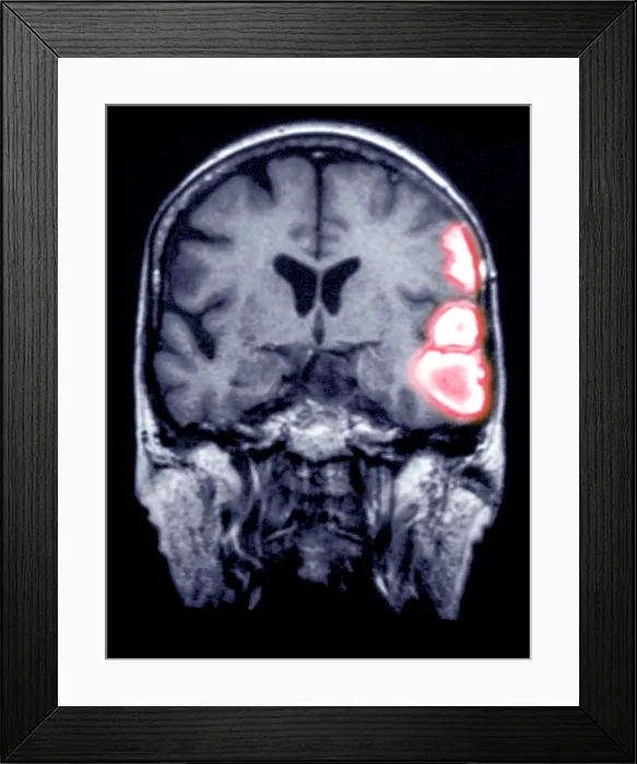 Framed Print : MRI Scan of a Brain Hemorrhage Framed Print : MRI Scan of a Brain Hemorrhage