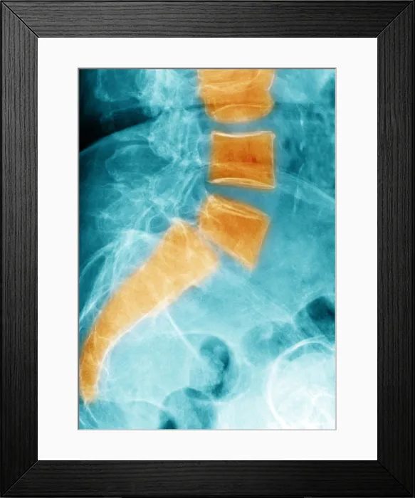 Framed Print : Spondylolisthesis Framed Print : Spondylolisthesis