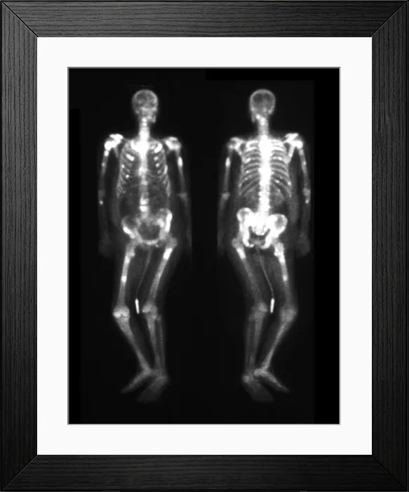 Framed Print : Bone scan showing multiple metastases Framed Print : Bone scan showing multiple metastases