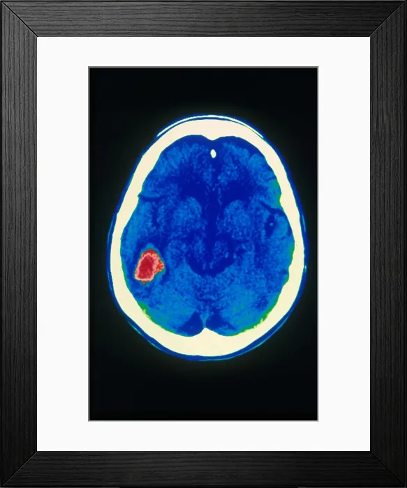 Framed Print : Stroke, CT Scan Framed Print : Stroke, CT Scan