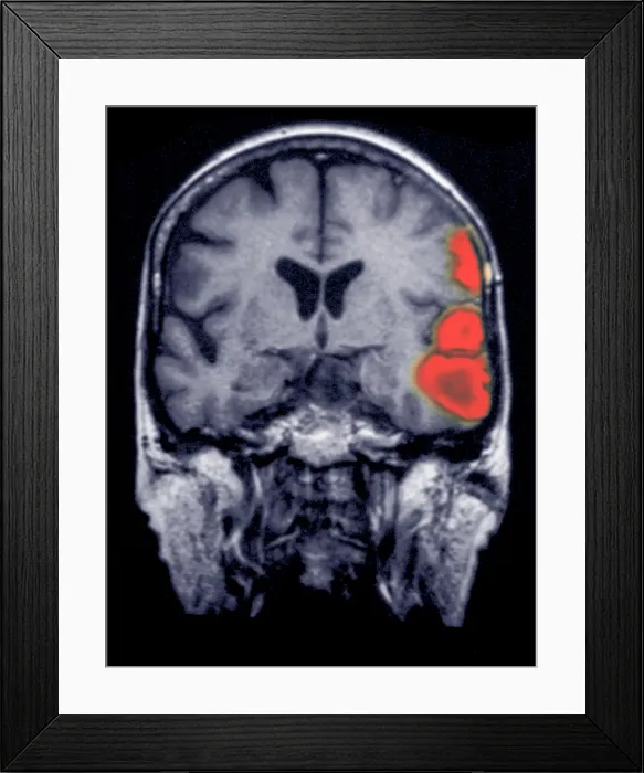 Framed Print : MRI of brain showing a stroke Framed Print : MRI of brain showing a stroke
