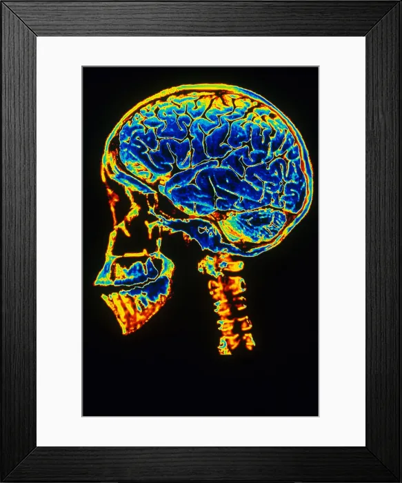 Framed Print : Skull With Brain Framed Print : Skull With Brain