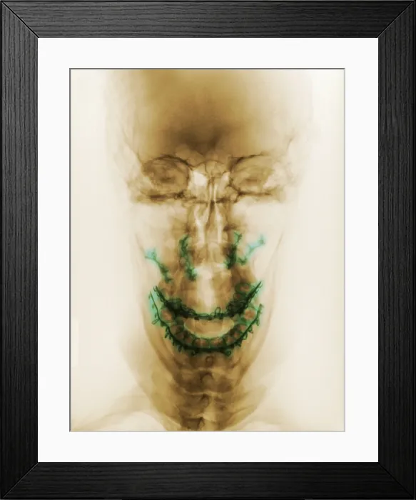 Framed Print : Post Operative X-ray of Patient with Facial Fractures Framed Print : Post Operative X-ray of Patient with Facial Fractures