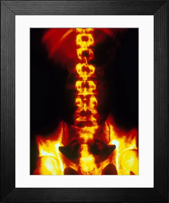 Framed Print : Normal Abdomen X-ray Framed Print : Normal Abdomen X-ray