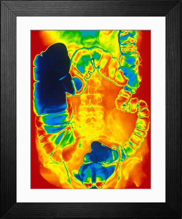 Framed Print : Large and Small Intestine, Barium X-ray