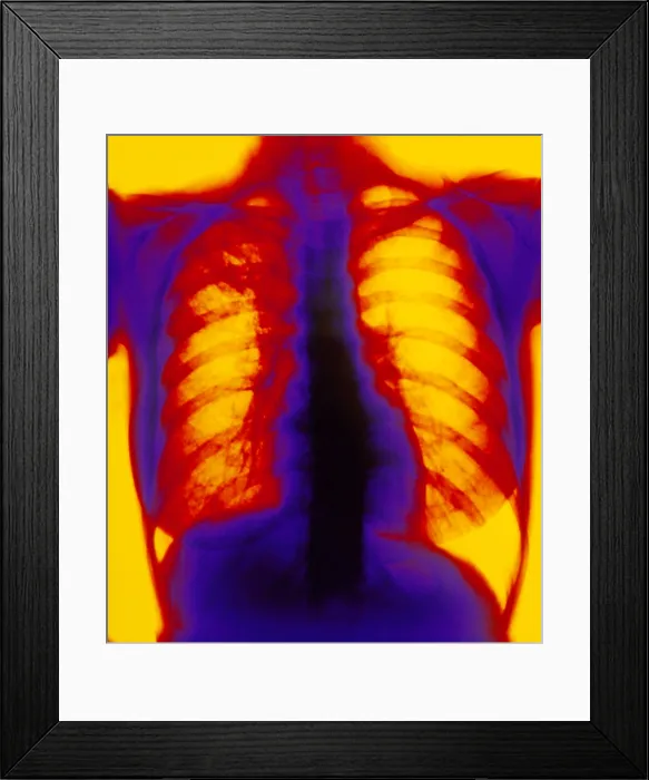 Framed Print : X-ray showing pulmonary tuberculosis Framed Print : X-ray showing pulmonary tuberculosis