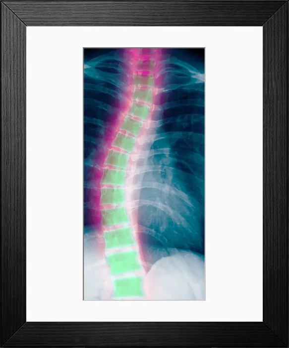 Framed Print : X-ray of scholiosis Framed Print : X-ray of scholiosis