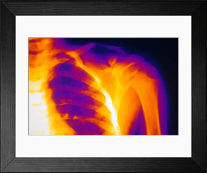 Framed Print : Child's Fractured Clavicle, X-ray Framed Print : Child's Fractured Clavicle, X-ray