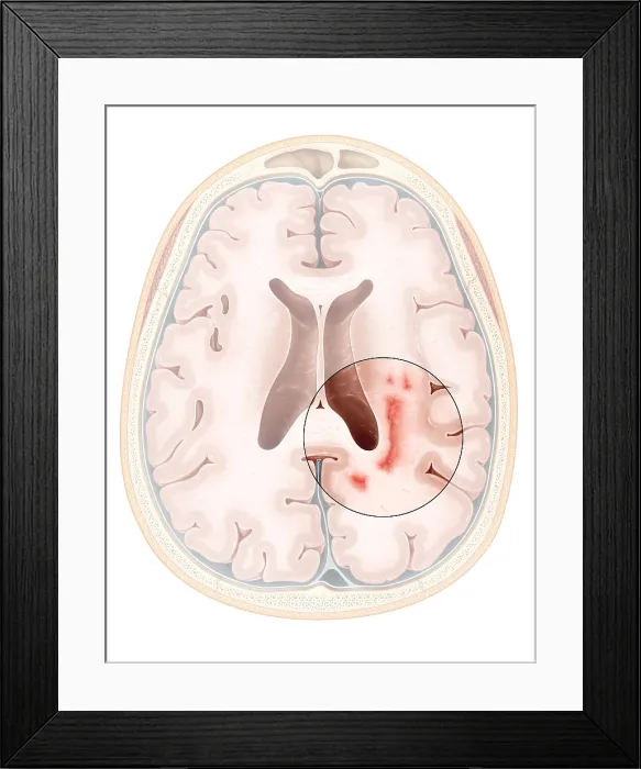Framed Print : Multiple Sclerosis Framed Print : Multiple Sclerosis