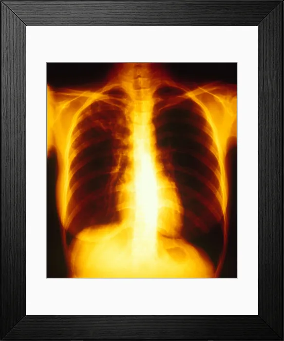 Framed Print : Tuberculosis, X-ray Framed Print : Tuberculosis, X-ray