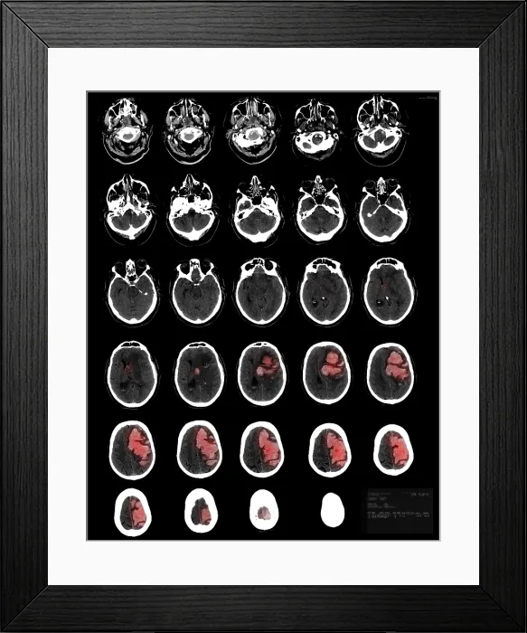 Framed Print : Stroke Montage, 82 year old man