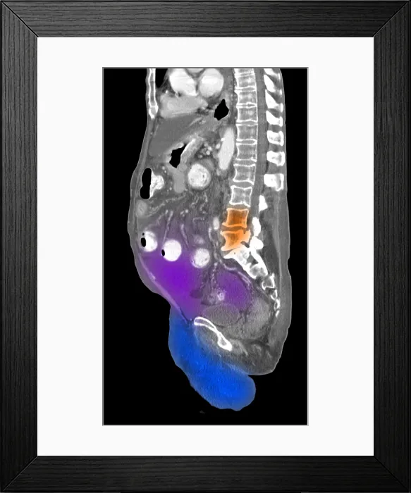 Framed Print : Ascites Fluid in Abdomen, CT Scan Framed Print : Ascites Fluid in Abdomen, CT Scan