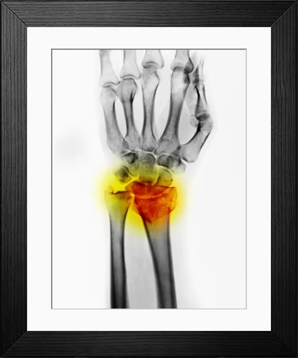 Framed Print : Colles Fracture