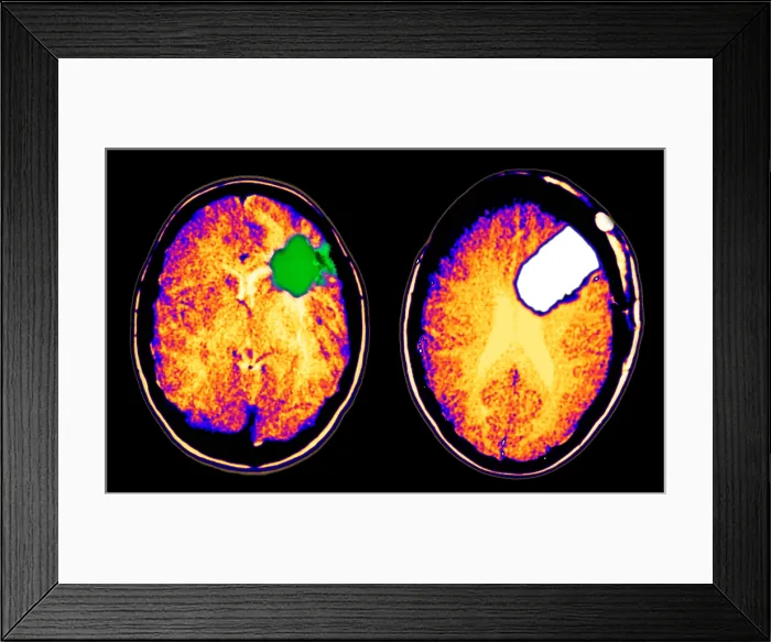 Framed Print : CT scan of brain glioma and tumor removal Framed Print : CT scan of brain glioma and tumor removal