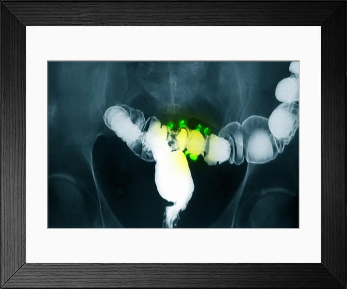 Framed Print : Colon x-ray with barium contrast