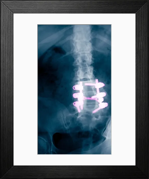 Framed Print : Spinal Fusion Framed Print : Spinal Fusion