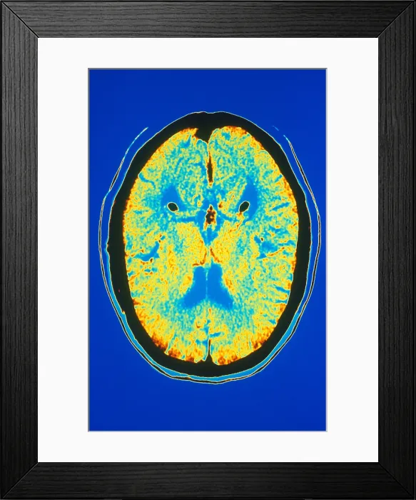 Framed Print : Brain, CT Scan Framed Print : Brain, CT Scan