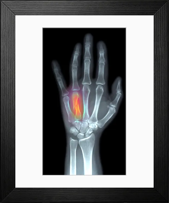 Framed Print : Fractured Metacarpal Framed Print : Fractured Metacarpal