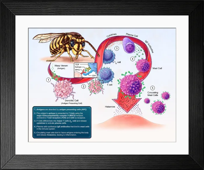 Framed Print : Allergy Development, illustration Framed Print : Allergy Development, illustration