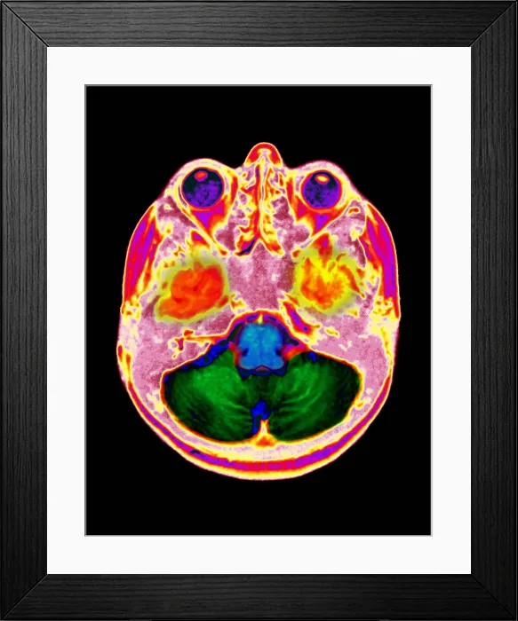 Framed Print : Normal MRI Framed Print : Normal MRI