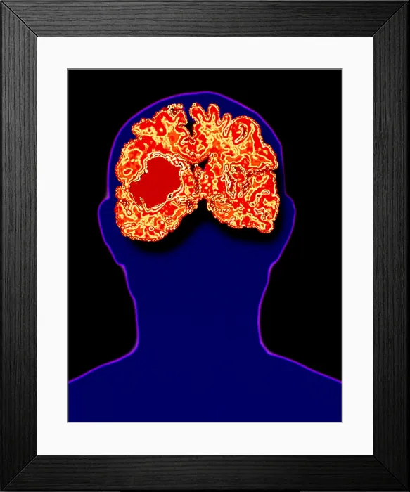 Framed Print : Head showing brain hemorrhage Framed Print : Head showing brain hemorrhage