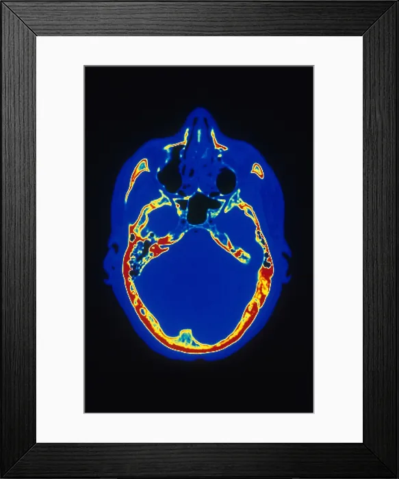 Framed Print : Head, CT Scan Framed Print : Head, CT Scan