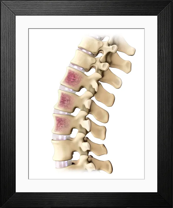 Framed Print : Multiple Myeloma, Spine Framed Print : Multiple Myeloma, Spine