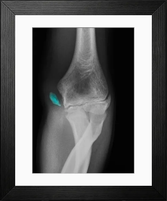 Framed Print : Little League Elbow Syndrome Framed Print : Little League Elbow Syndrome