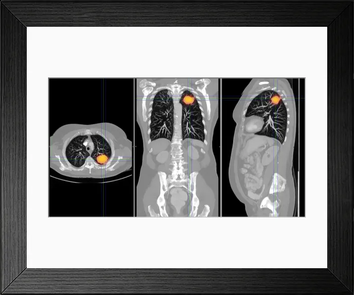 Framed Print : Lung Cancer, CT Scan