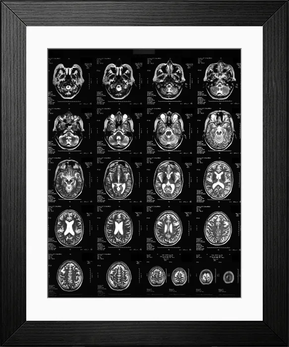 Framed Print : Normal Brain, 62-Year-Old Woman, MRI Framed Print : Normal Brain, 62-Year-Old Woman, MRI