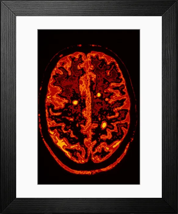 Framed Print : Multiple sclerosis Framed Print : Multiple sclerosis