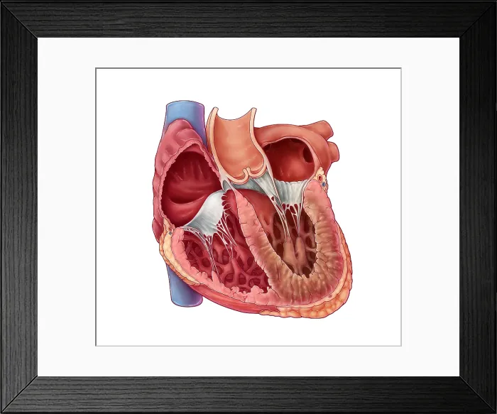 Framed Print : Restrictive Cardiomyopathy Framed Print : Restrictive Cardiomyopathy