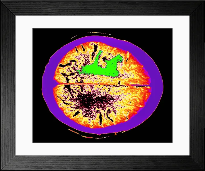 Framed Print : Brain edema Framed Print : Brain edema