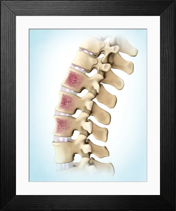 Framed Print : Multiple Myeloma, Spine Framed Print : Multiple Myeloma, Spine