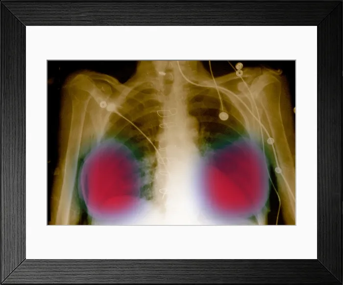 Framed Print : Silicone breast implants