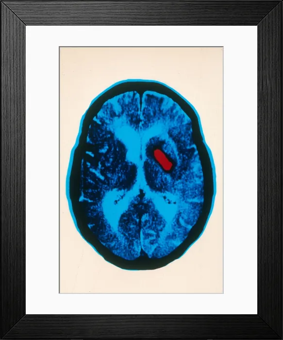 Framed Print : Hemorrhagic stroke, CT Scan Framed Print : Hemorrhagic stroke, CT Scan