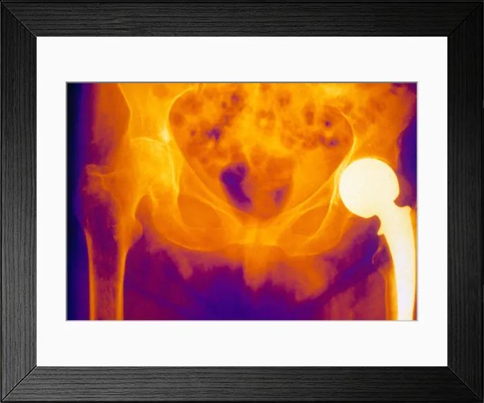 Framed Print : Hip Replacement and Osteoporosis, X-ray Framed Print : Hip Replacement and Osteoporosis, X-ray
