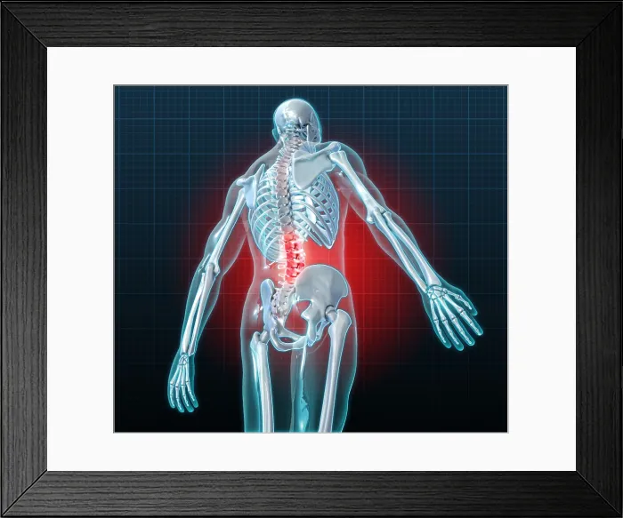 Framed Print : Lower Back Pain, Illustration Framed Print : Lower Back Pain, Illustration