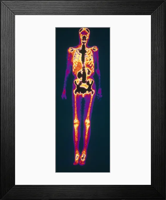 Framed Print : Metastatic Lung Cancer