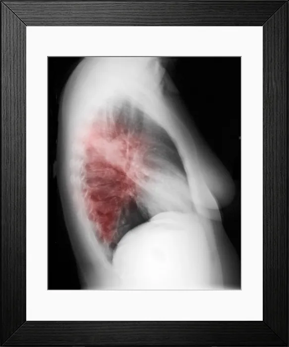 Framed Print : Walking Pneumonia Framed Print : Walking Pneumonia