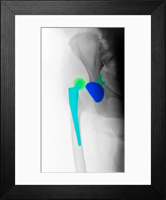 Framed Print : X-ray Showing Hip Dislocation Framed Print : X-ray Showing Hip Dislocation